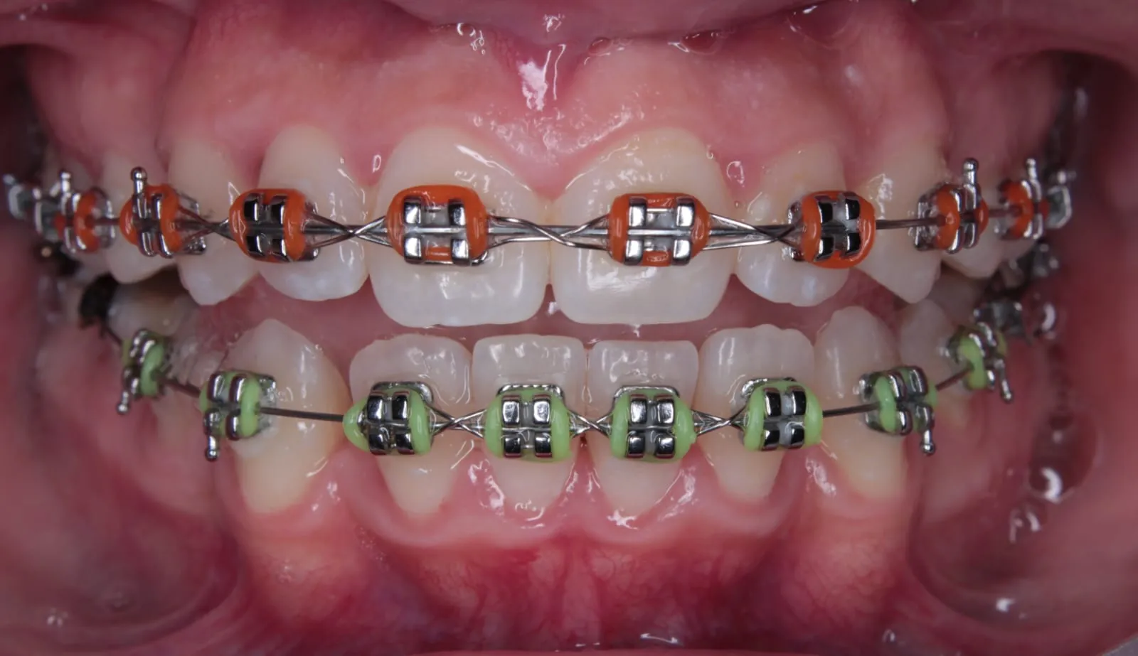 Brackets metálicos con ligas naranjas arriba y verdes abajo