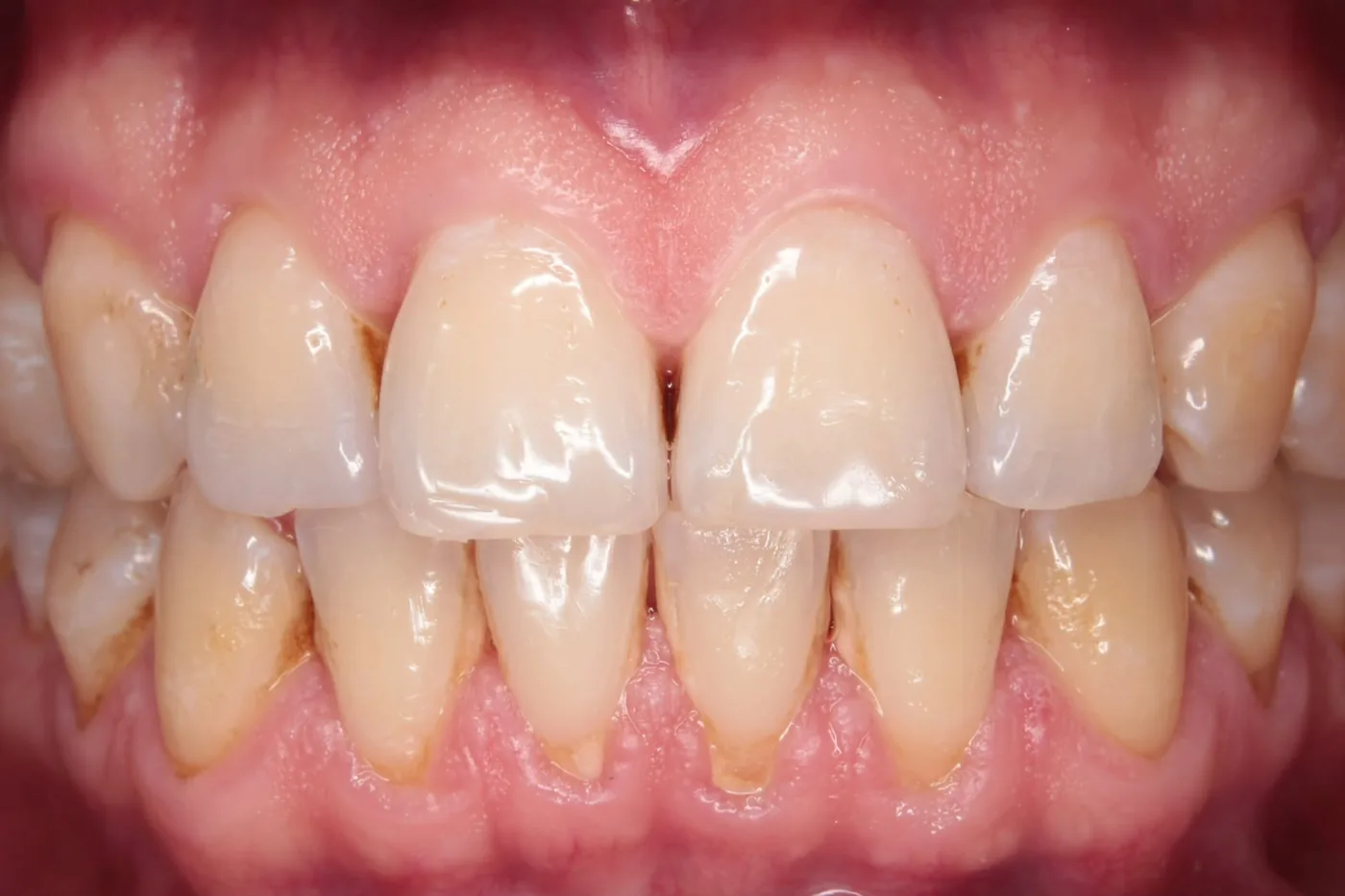 Antes: dientes con sarro y manchas