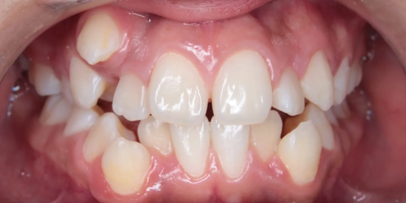 Antes: dientes apiñados con caninos fuera de lugar