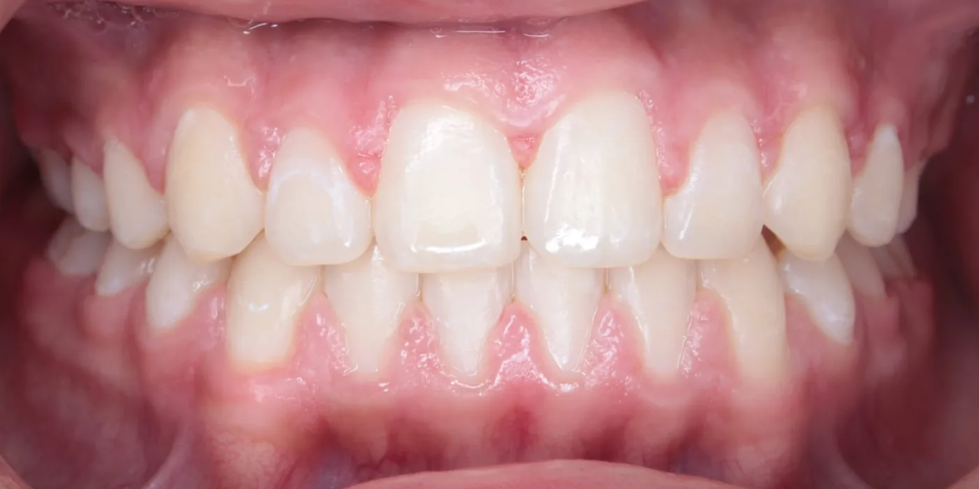 Después: el mismo paciente con los dientes alineados tras la ortodoncia
